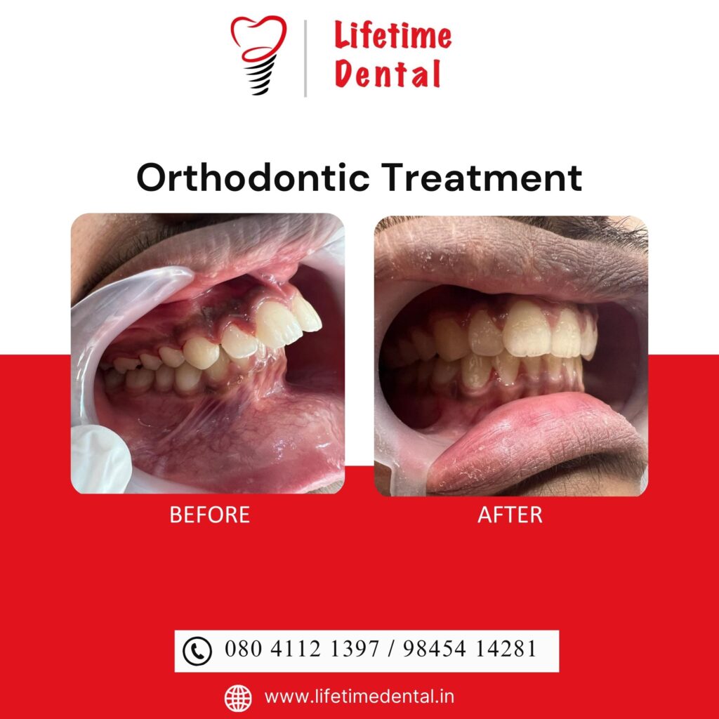 Invisible Braces - Best Orthodontist in Bangalore