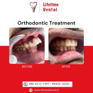 Invisible Braces – Best Orthodontist in Bangalore