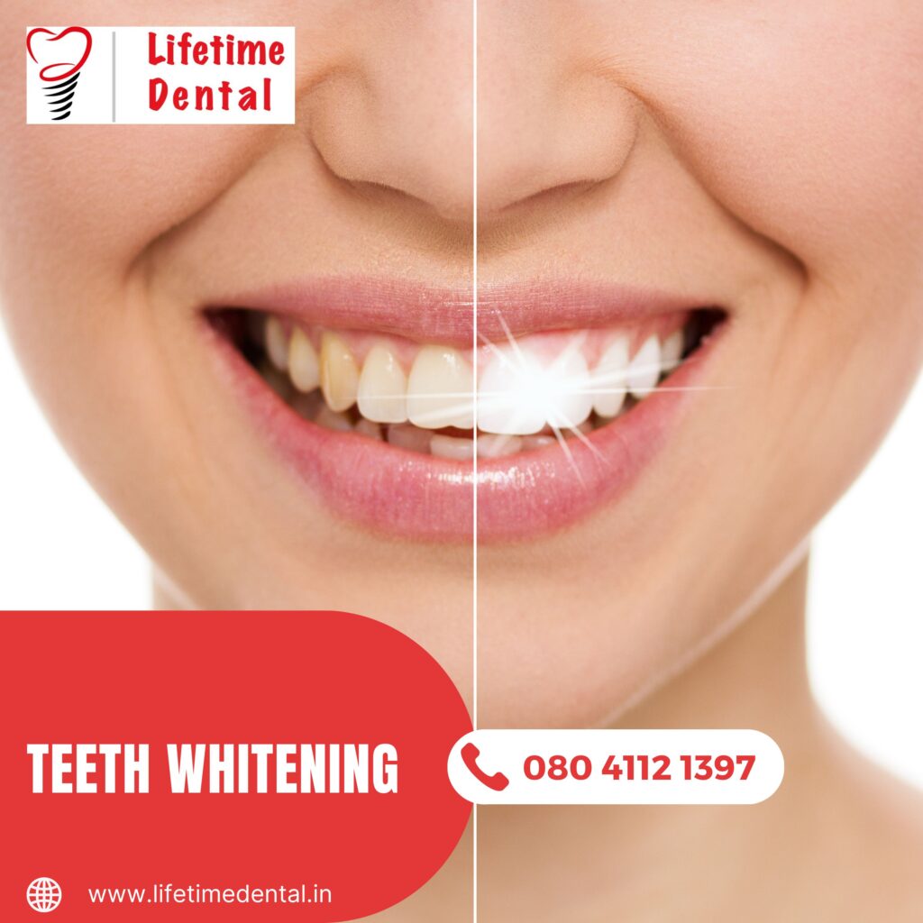 Teeth Whitening treatment near me - The Fastest Smile Makeover