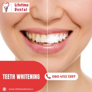 Teeth Whitening treatment near me – The Fastest Smile Makeover