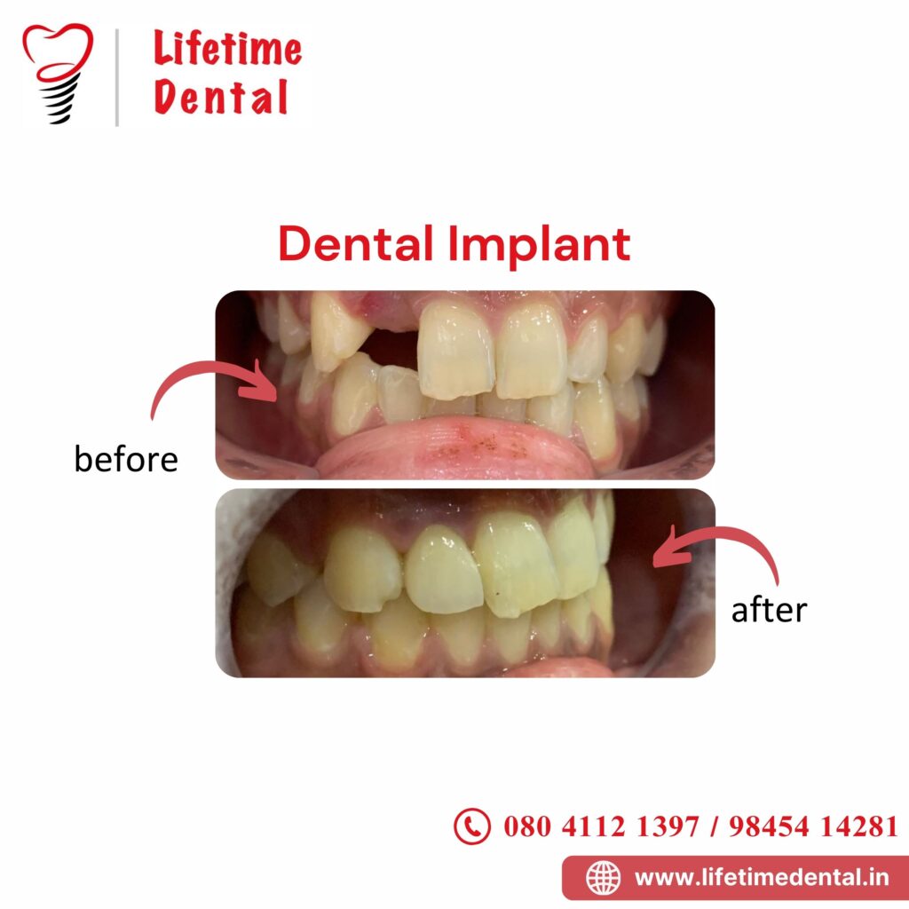 Dental Implants - Best Dental Implant treatment in Bangalore