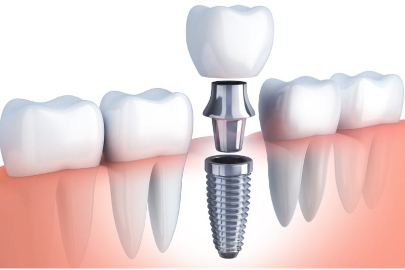 Why is it important to visit the right Dental Implant Specialist for replacement of teeth?