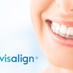 Invisalign Treatment In Bangalore