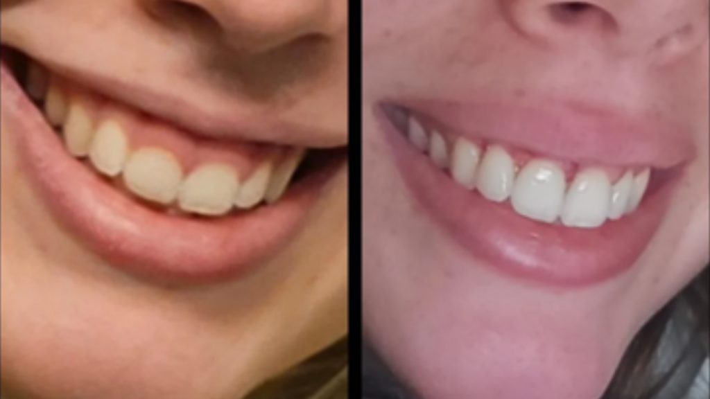 Gum contouring for a balanced smile