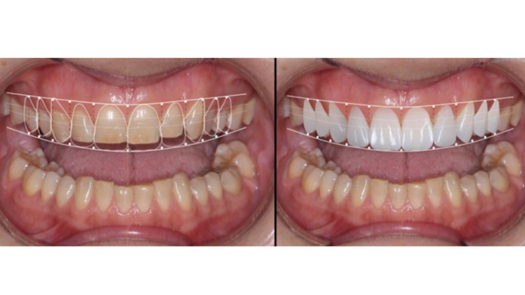 Digital smile design planning