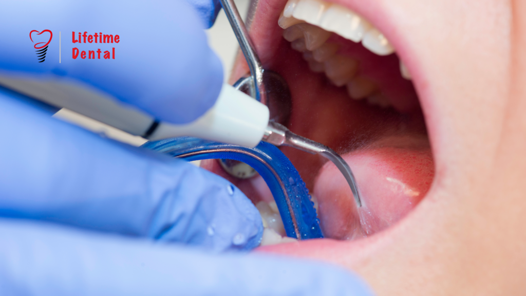 Importance of Teeth cleaning | Dental Scaling
