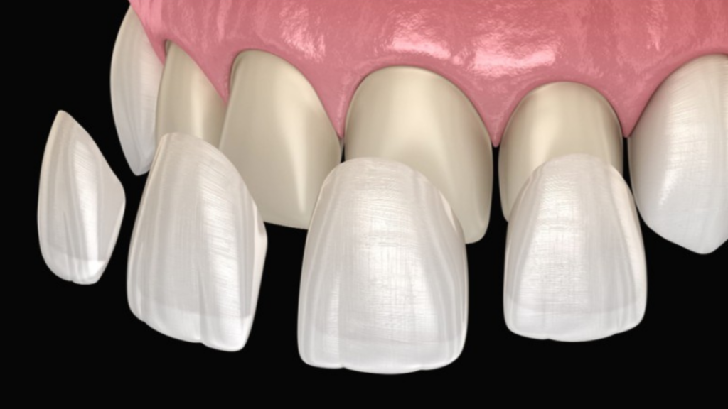 Dental veneers for aesthetic dentistry