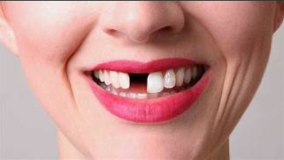 The Hidden Cost of Waiting Too Long: What Can Happen When a Missing Tooth Is Left Untreated?